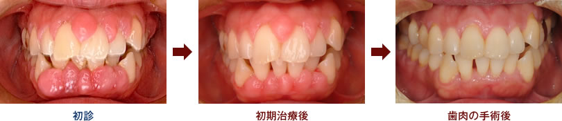 歯周病治療 症例