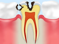 神経に近い虫歯