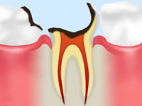 末期の虫歯歯