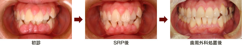 SRP(超音波による歯石除去)の症例